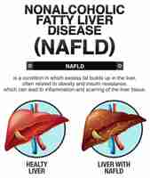 무료 벡터 비알코올성 지방간 질환