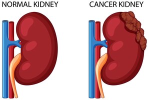 Free vector normal kidney and cancer kidney