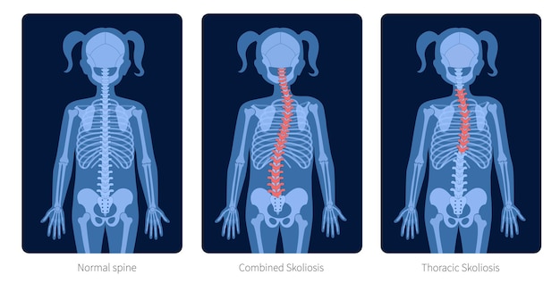 正常な​脊椎​、​小児​の​身体​における​複合​および​胸椎側​弯症​。 x線​フラット​ベクトル図​。​女の子​の​シルエット​の​背骨​と​骨格​の​解剖学​。​整形​外科​の​ポスター​。​脊椎痛​センター​で​の​健康​診断