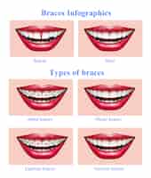 Free vector opened mouth with red glossy lips showing  metal plastic ceramic teeth braces types realistic infographic