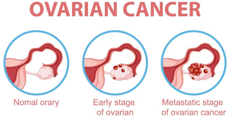 Free Vector ovarian cancer development process infographic