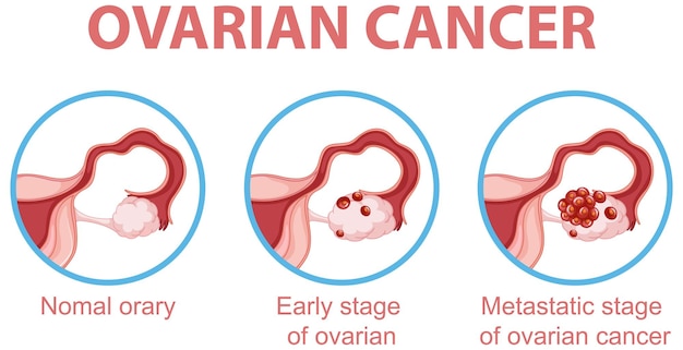 Инфографика процесса развития рака яичников