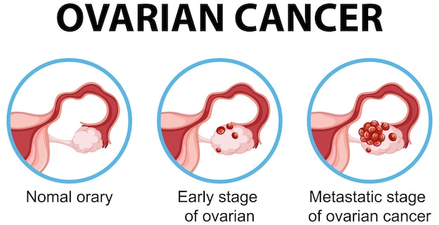 Free vector ovarian cancer development process infographic