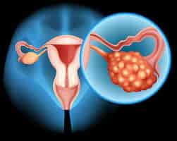 Free vector ovarian cancer diagram in detail