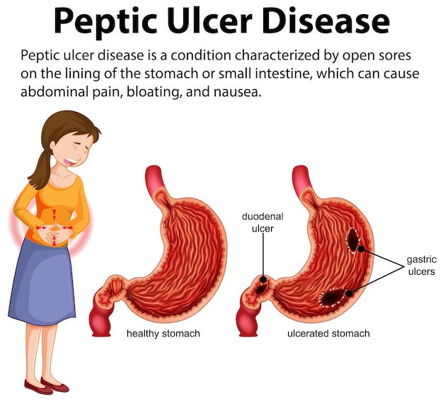 Peptic ulcer disease infographic