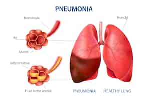 Free vector pneumonia realistic infographic