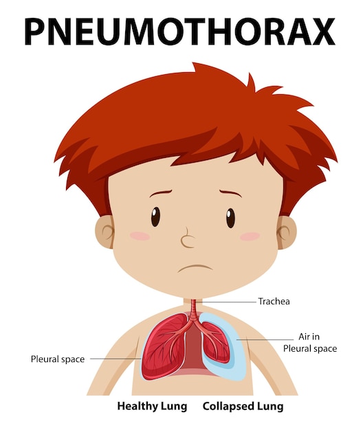 Pneumothorax diagram of human anatomy