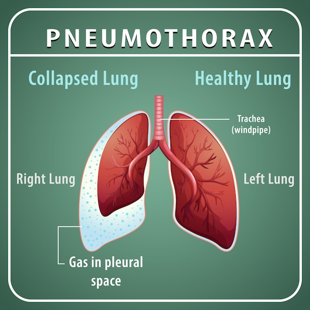 Vettore gratuito diagramma del pneumotorace con polmone collassato e polmone sano