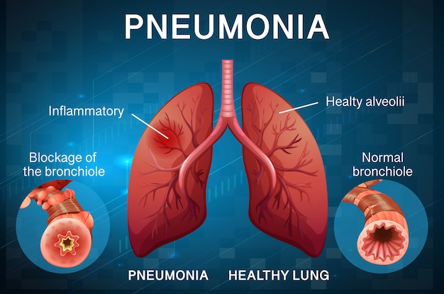 Free vector poster design for pneumonia with human lungs