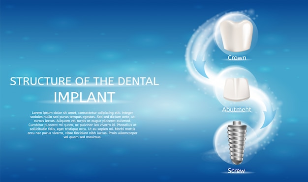 Realistic image structure of the dental implant