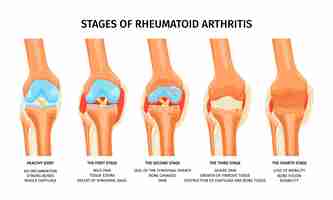 無料ベクター 膝関節の関節リウマチの 4 つの段階を示す現実的なインフォ グラフィック ベクトル イラスト