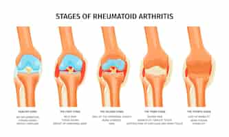 Free vector realistic infographics showing four stages of rheumatoid arthritis of knee joint vector illustration