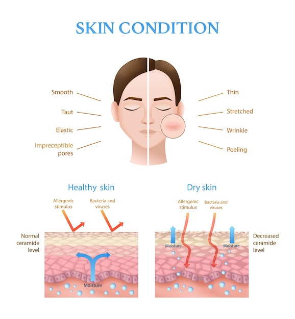 Free vector realistic infographics showing structure of human healthy and dry skin with normal and decreased ceramide level vector illustration