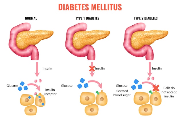 Free vector realistic pancreas anatomy insulin diabetes mellitus infographics with notmal and damaged pancreas with editable text captions vector illustration