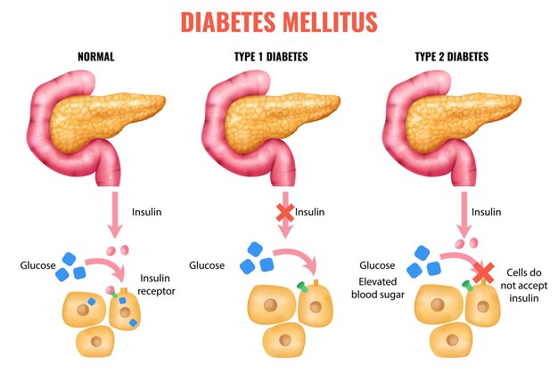 Free Vector | Diabetes complications medical educational chart with  affected human organs damages depiction and description flat