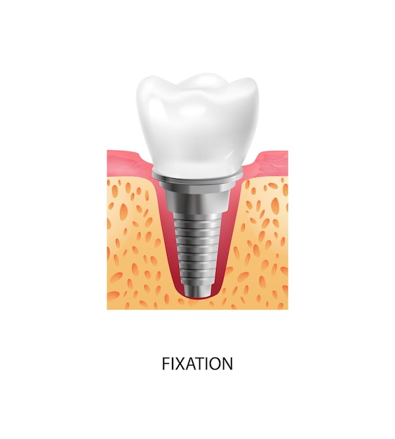 Realistic tooth stages dental implant composition with text and view of fixation stage of dental implantation vector illustration