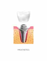 無料ベクター 歯科インプラント組成のリアルな歯