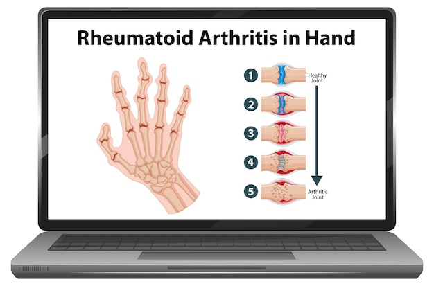 Free vector rheumatoid arthritis symptoms on hand on laptop screen