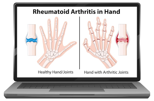 Rheumatoid arthritis symptoms on hand on laptop screen