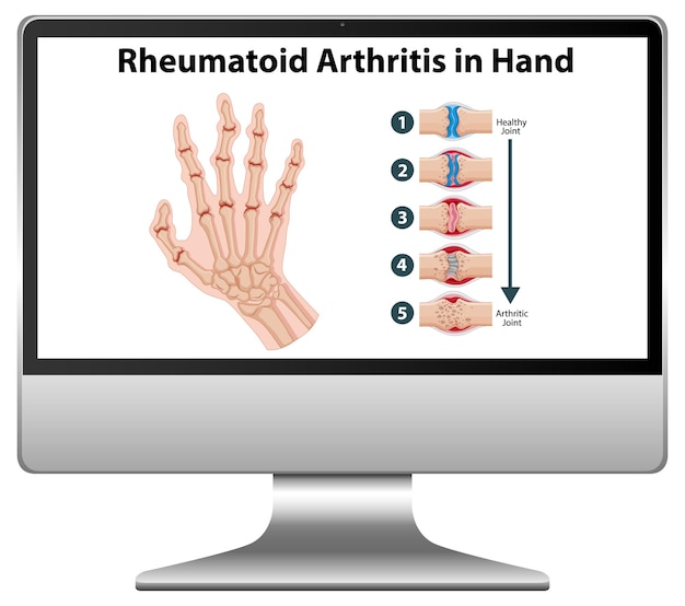 無料ベクター コンピューターのデスクトップに手元にある関節リウマチの症状