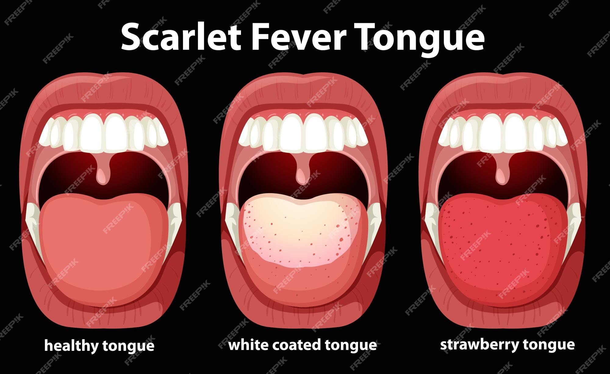 Scarlet fever mouth with symptoms of scarlatina Vector Image