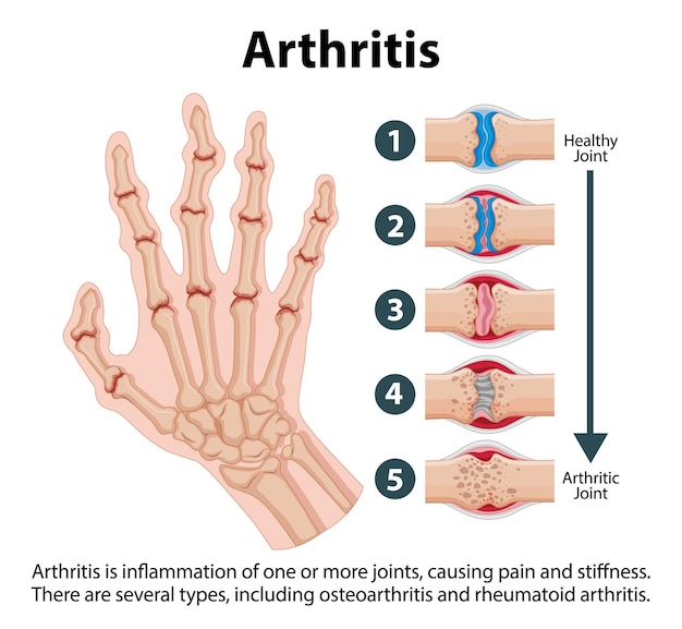 Free vector science education human anatomy and arthritis stages