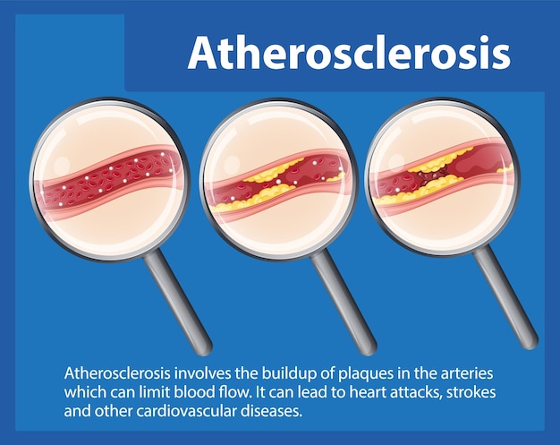 Free vector science education human anatomy and atherosclerosis development