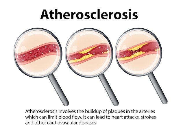 Free vector science education human anatomy and atherosclerosis development