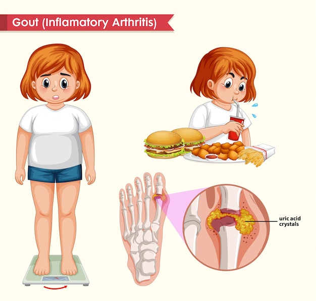 Vettore gratuito illustrazione medica scientifica del concetto di gotta