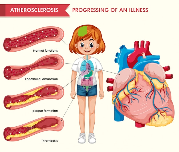 Scientific medical infographic of atherosclerosis