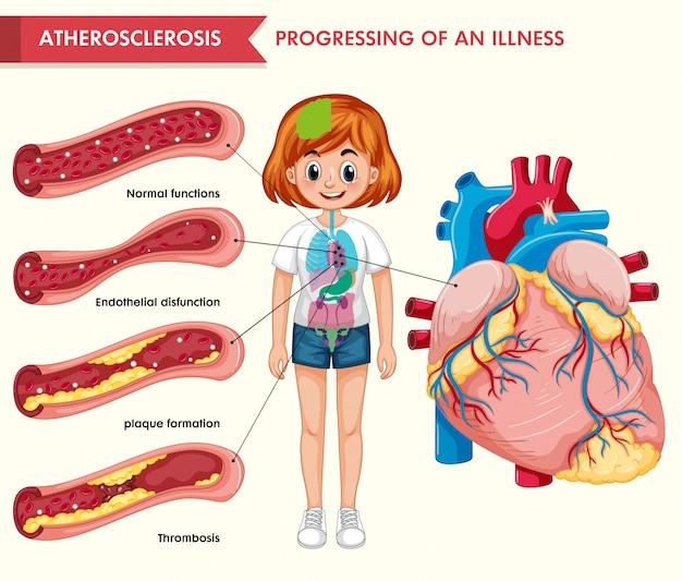 アテローム性動脈硬化の科学的医療インフォグラフィック