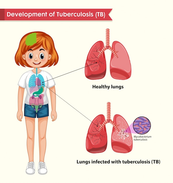 Научно-медицинская инфографика туберкулеза
