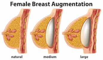 Free vector a set of female breast augmentation