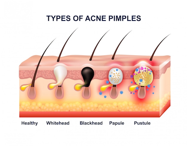 Composizione di anatomia dell'acne della pelle