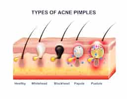 Vettore gratuito composizione di anatomia dell'acne della pelle