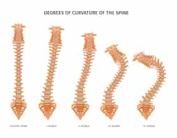 Free vector spine structure anatomy set of isolated icons showing various degrees of spine curvature healthy and ill vector illustration