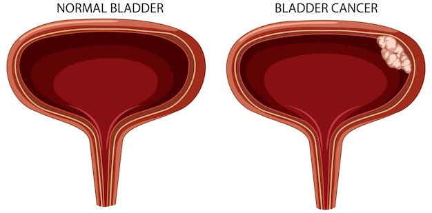 Free vector stage of bladder cancer