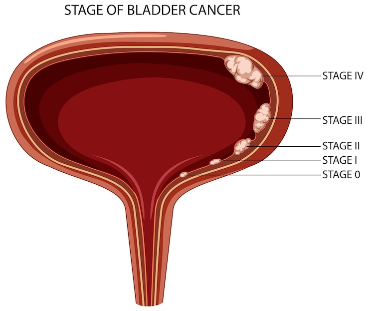 Free Vector stage of bladder cancer