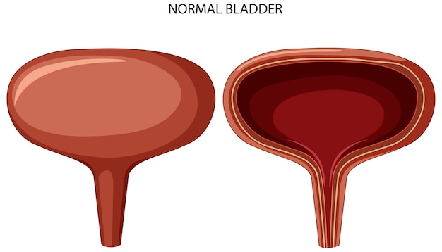 Free vector stage of bladder cancer