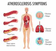 Free vector stages of atherosclerosis information infographic