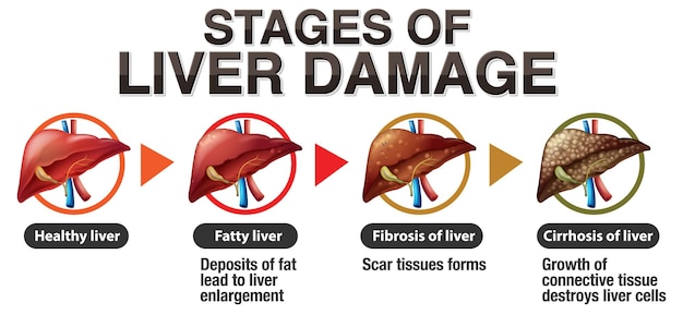 Infografica sulle fasi del danno epatico