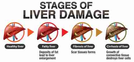Free vector stages of liver damage infographic
