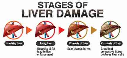 Vettore gratuito infografica sulle fasi del danno epatico