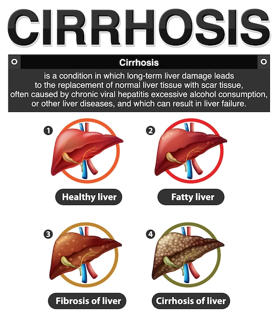 Stages of Liver Damage Infographic