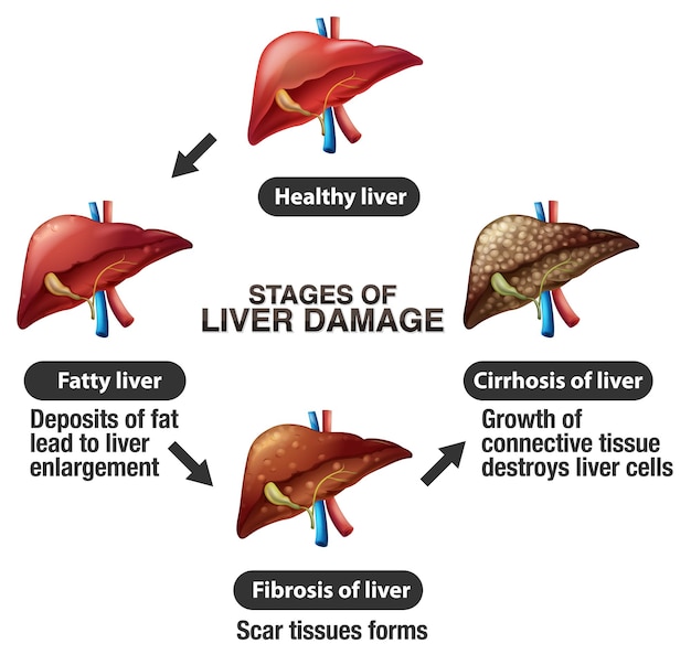 Free vector stages of liver damage infographic