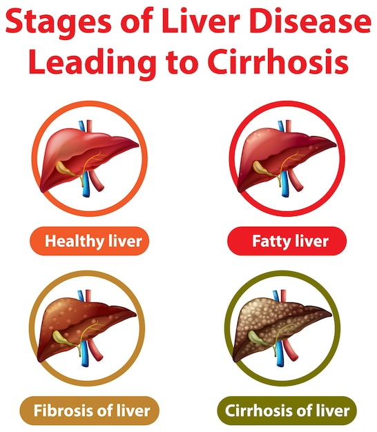 Free vector stages of liver disease leading to cirrhosis