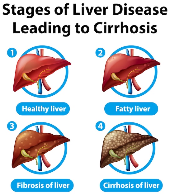 Free vector stages of liver disease leading to cirrhosis