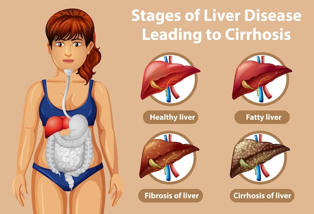 Stages of liver disease leading to cirrhosis