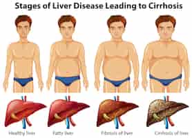 Free vector stages of liver disease leading to cirrhosis