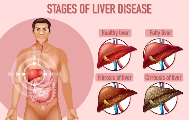 Free vector stages of liver disease